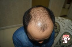 -大麦微针植发丨全国连锁