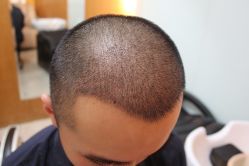 点击看大图 -大麦微针植发丨全国连锁