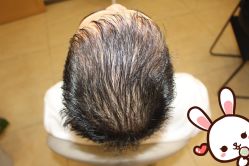 -大麦微针植发丨全国连锁