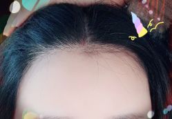 -大麦微针植发全国连锁