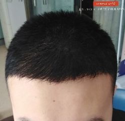 -大麦微针植发丨全国连锁