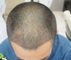 -大麦微针植发丨全国连锁