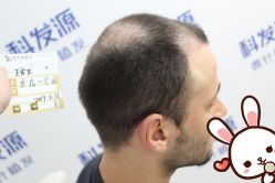 点击看大图 -大麦微针植发丨全国连锁