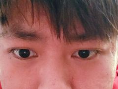 -黑马眼科·近视手术