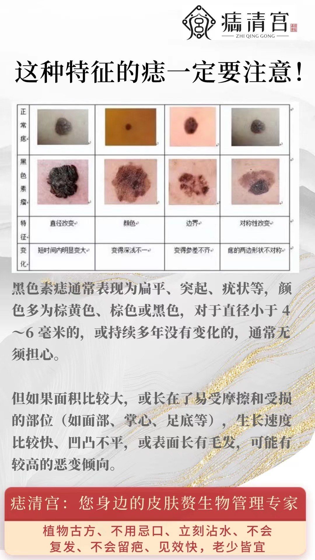 对于容易反复摩擦的部位的痣,需要给予更多的关注,因为这些痣容易发生