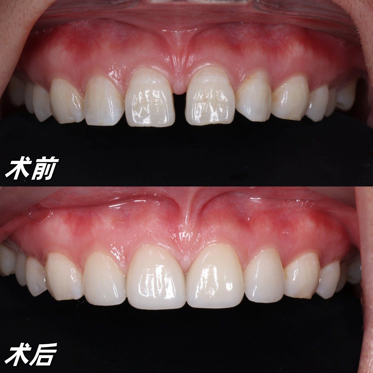 牙齿修复超简单