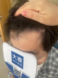-大麦微针植发丨全国连锁