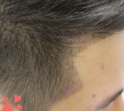 -大麦微针植发丨全国连锁