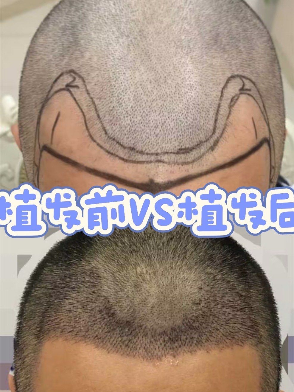 微针植发术后第7天分享
