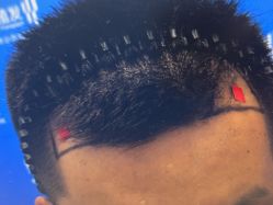 点击看大图 -雍禾植发全国连锁