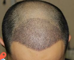 -大麦微针植发丨全国连锁