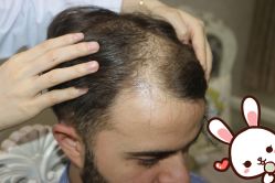 点击看大图 -大麦微针植发丨全国连锁