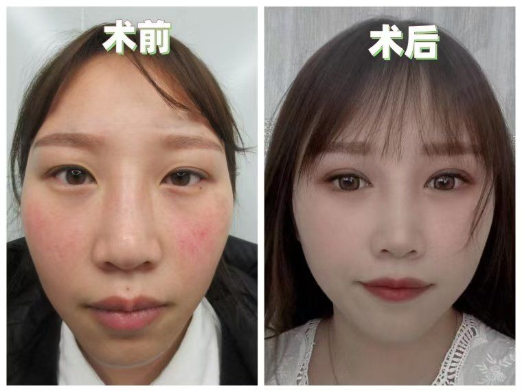 换头术,换头术首例成功 换头术,换头术首例成功