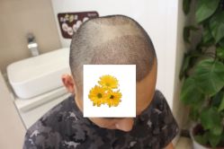-大麦微针植发丨全国连锁