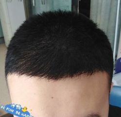 -大麦微针植发丨全国连锁