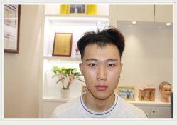 -大麦微针植发全国连锁