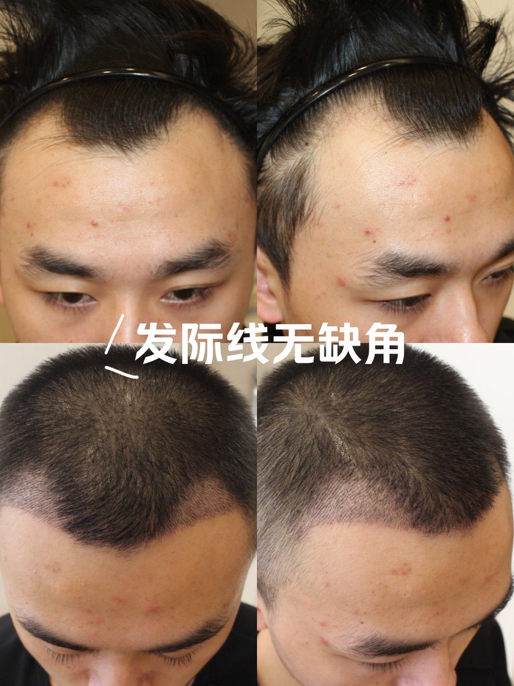 发际线种植后的效果很自然!