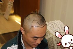 点击看大图 -大麦微针植发丨全国连锁