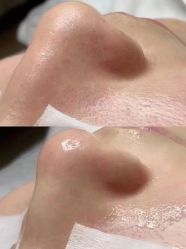 -靓芙泉专研痘痘肌