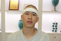 -大麦微针植发丨全国连锁