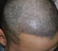 -大麦微针植发全国连锁