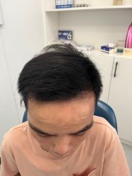 体验后-大麦微针植发全国连锁