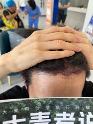 点击看大图 -大麦微针植发全国连锁