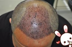 -大麦微针植发丨全国连锁