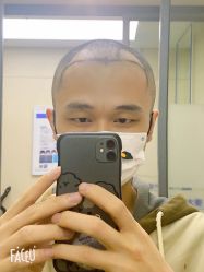 -大麦微针植发全国连锁