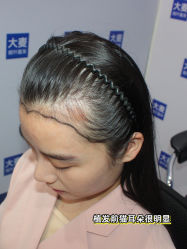 -大麦微针植发丨全国连锁