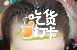 -大麦微针植发全国连锁