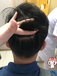 -大麦微针植发丨全国连锁