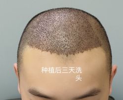 -牛大夫植发
