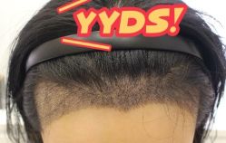 -大麦微针植发丨全国连锁