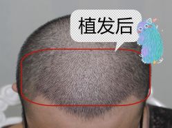 -大麦微针植发全国连锁