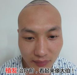 -碧莲盛·不剃发植发