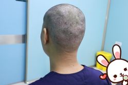 点击看大图 -大麦微针植发丨全国连锁