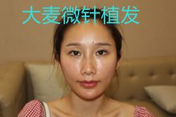 -大麦微针植发丨全国连锁