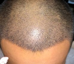 -大麦微针植发丨全国连锁