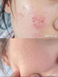 -苗方清颜痘肌研究所