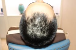 -大麦微针植发丨全国连锁