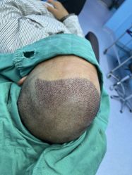 -大麦微针植发全国连锁