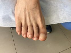 -德哥灰指甲脚气甲沟炎跖疣护理