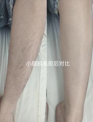 -薇兰专业脱毛连锁机构