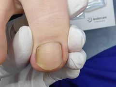 -Andrew指甲专科灰指甲·甲沟炎矫正·3D步态矫形鞋垫定制(上海法华镇路旗舰店)
