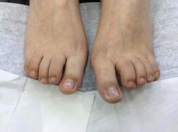 -德哥灰指甲脚气甲沟炎跖疣护理