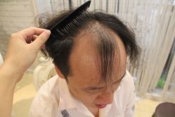 -大麦微针植发丨全国连锁