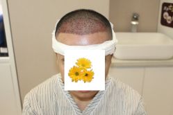 -大麦微针植发丨全国连锁