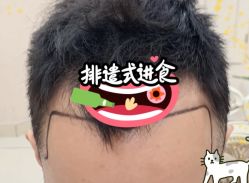 -大麦微针植发全国连锁