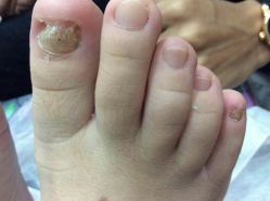 点击看大图 -德哥灰指甲脚气甲沟炎跖疣护理